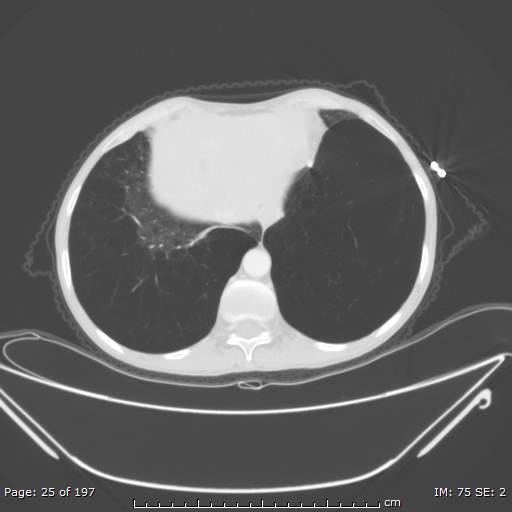 Alpha-1-antitrypsin deficiency (Radiopaedia 50561-55987 Axial lung window 11).jpg