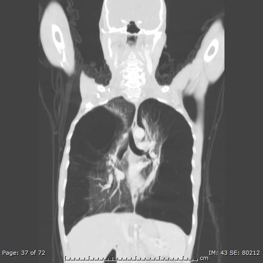 Alpha-1-antitrypsin deficiency (Radiopaedia 50561-55987 Coronal lung window 35).jpg