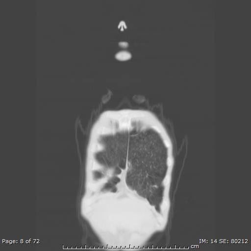 Alpha-1-antitrypsin deficiency (Radiopaedia 50561-55987 Coronal lung window 6).jpg