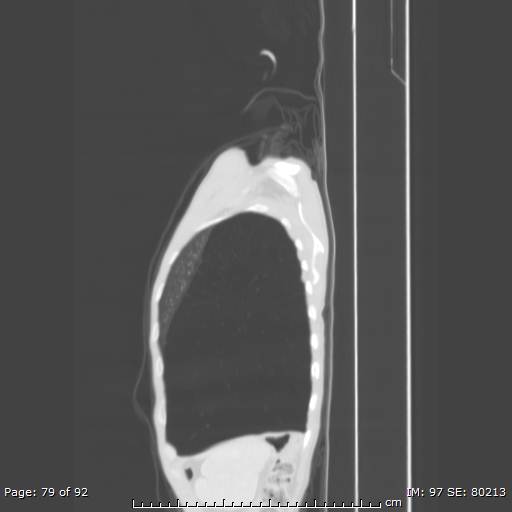 File:Alpha-1-antitrypsin deficiency (Radiopaedia 50561-55987 Sagittal lung window 38).jpg