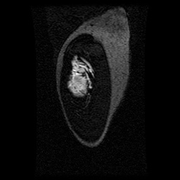 Alveolar soft part sarcoma (Radiopaedia 64501-73678 D 124).jpg