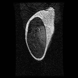 Alveolar soft part sarcoma (Radiopaedia 64501-73678 D 129).jpg