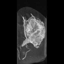 Alveolar soft part sarcoma (Radiopaedia 64501-73678 D 15).jpg