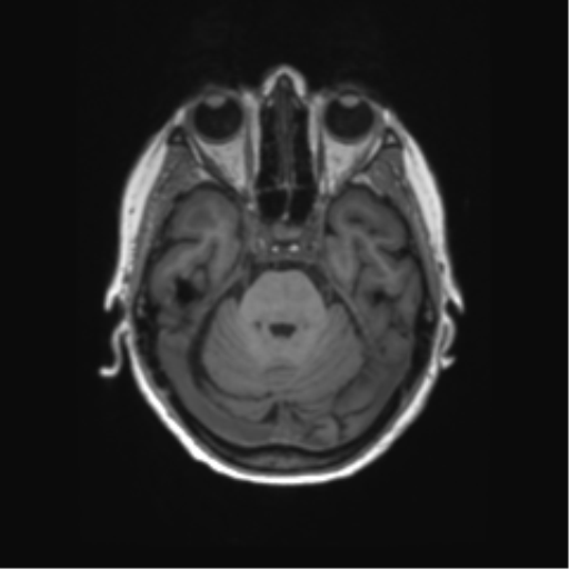 File:Alzheimer's disease (Radiopaedia 42658-45802 Axial T1 108).png