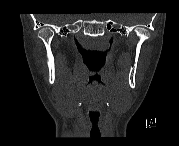 File:Ameloblastoma (Radiopaedia 26645-26793 bone window 20).jpg