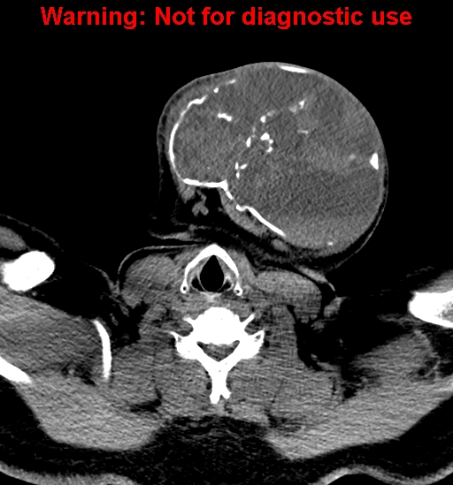 File:Ameloblastoma (Radiopaedia 33126-34164 A 27).jpg