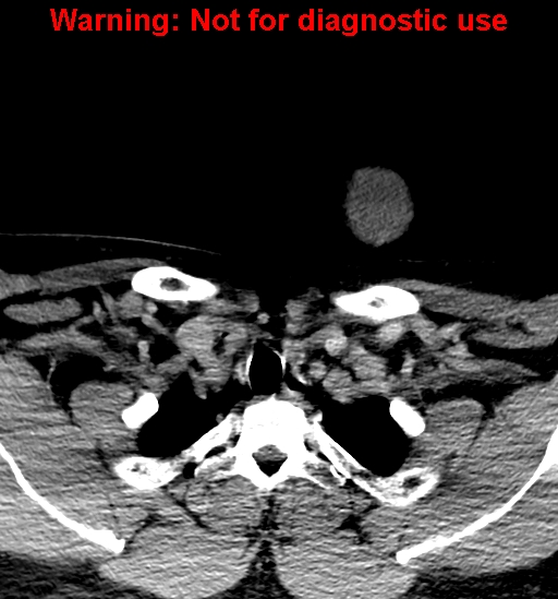 File:Ameloblastoma (Radiopaedia 33126-34164 B 44).jpg