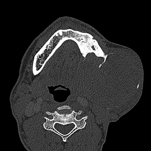 Ameloblastoma (Radiopaedia 51921-57766 Axial bone window 48).jpg