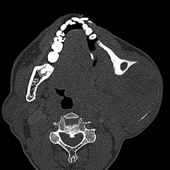 Ameloblastoma (Radiopaedia 51921-57766 Axial bone window 73).jpg