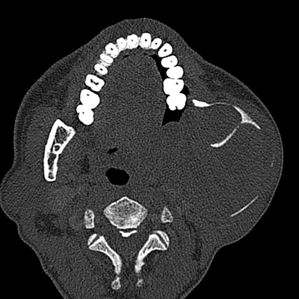 Ameloblastoma (Radiopaedia 51921-57766 Axial bone window 84).jpg