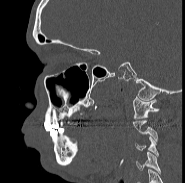 Ameloblastoma (Radiopaedia 77750-89997 Sagittal bone window 23).jpg