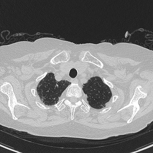 Amiodarone-induced pulmonary fibrosis (Radiopaedia 82355-96460 Axial lung window 8).jpg