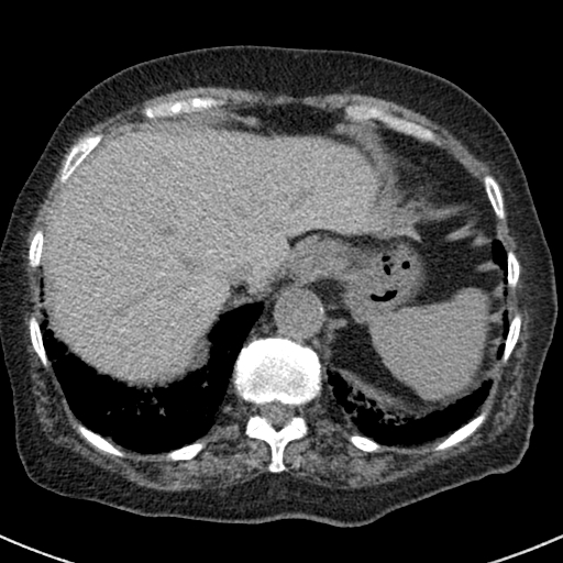 File:Amiodarone-induced pulmonary fibrosis (Radiopaedia 82355-96460 Axial non-contrast 52).jpg