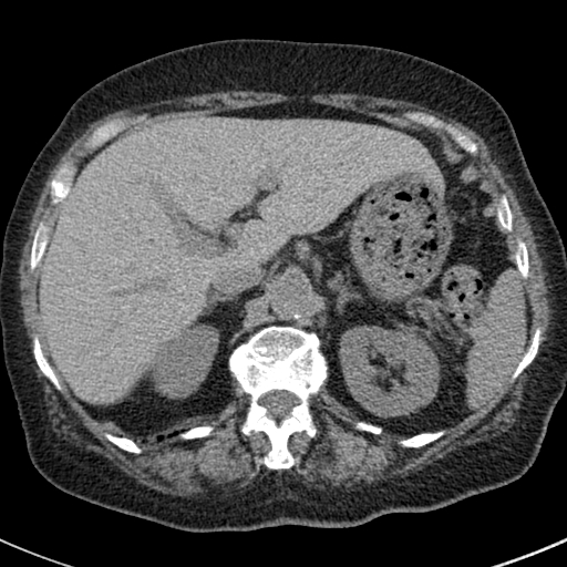File:Amiodarone-induced pulmonary fibrosis (Radiopaedia 82355-96460 Axial non-contrast 59).jpg
