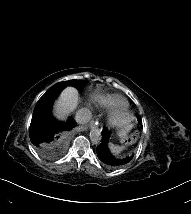 Amiodarone deposition in the liver (Radiopaedia 77587-89780 Axial non-contrast 65).jpg