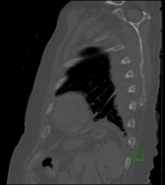 Amiodarone deposition in the liver (Radiopaedia 77587-89780 Sagittal bone window 22).jpg