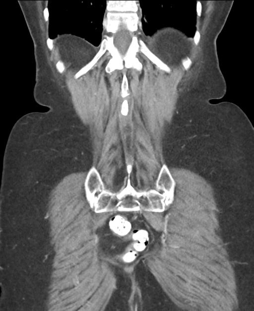 Ampullary adenocarcinoma (Radiopaedia 34013-35237 E 43).png