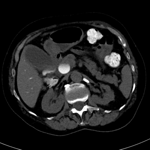 File:Ampullary adenocarcinoma (Radiopaedia 34013-35241 AXIAL THICK 32).png