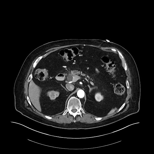 File:Ampullary adenocarcinoma (Radiopaedia 59373-66734 Axial 6).jpg