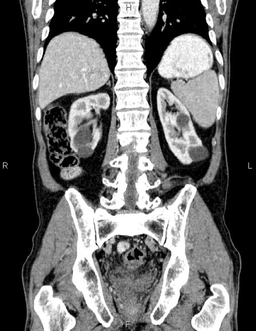 Ampullary adenocarcinoma (Radiopaedia 86093-102032 C 48).jpg
