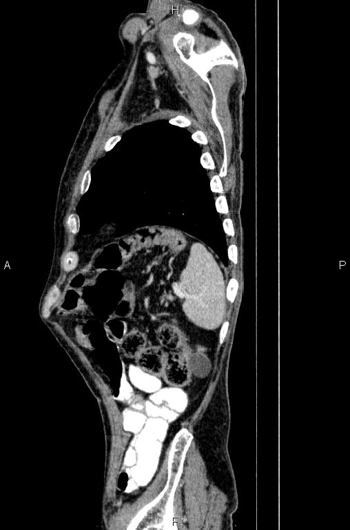 Ampullary adenocarcinoma (Radiopaedia 86093-102033 E 79).jpg