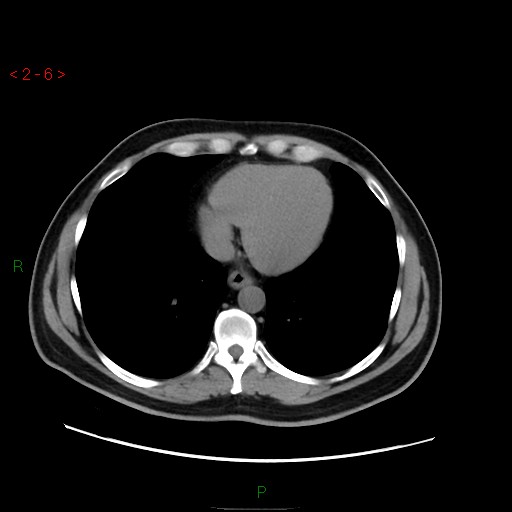 File:Ampullary carcinoma (Radiopaedia 56396-63056 Axial non-contrast 4).jpg