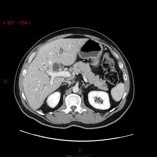 File:Ampullary carcinoma (Radiopaedia 56396-63056 C 30).jpg