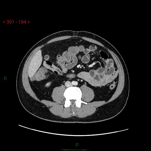 File:Ampullary carcinoma (Radiopaedia 56396-63056 C 57).jpg