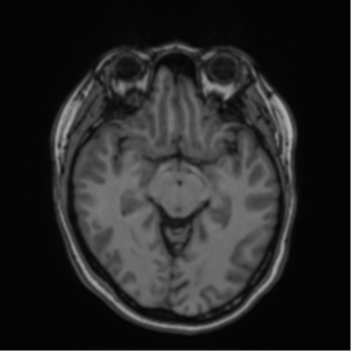 Anaplastic astroblastoma (Radiopaedia 55666-62194 Axial T1 32).png