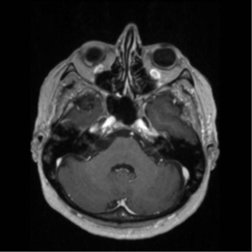 File:Anaplastic astrocytoma IDH wild-type (pseudoprogression) (Radiopaedia 42209-45276 Axial T1 C+ 42).png
