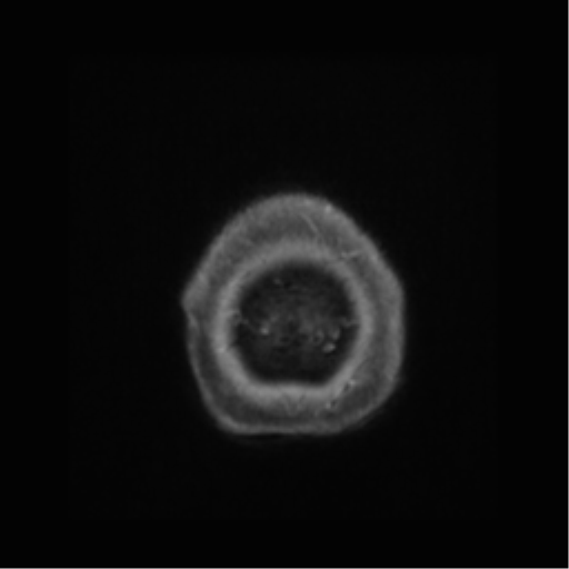 Anaplastic astrocytoma IDH wild-type (pseudoprogression) (Radiopaedia 42209-45277 Axial T1 C+ 131).png
