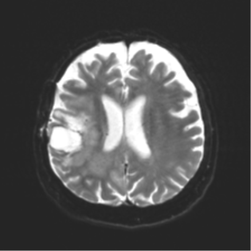 Anaplastic astrocytoma IDH wild-type (pseudoprogression) (Radiopaedia 42209-45279 Axial DWI 17).png