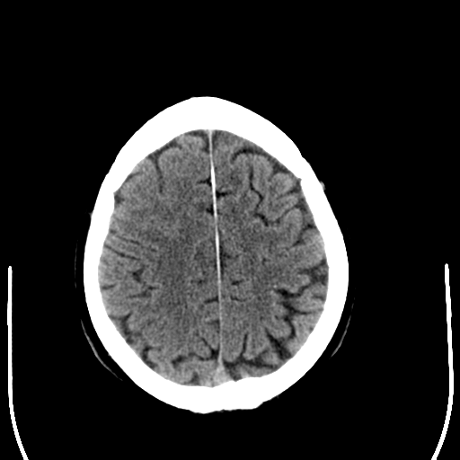 File:Anaplastic meningioma with recurrence (Radiopaedia 34452-35781 Axial non-contrast 26).png