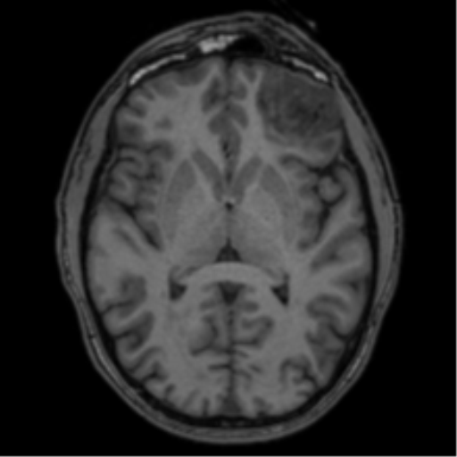 Anaplastic oligodendroglioma with skull fracture (Radiopaedia 74831-85845 Axial T1 32).png