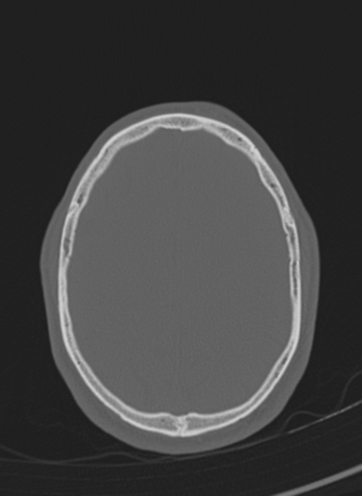 Anaplastic oligodendroglioma with skull fracture (Radiopaedia 74831-85846 Axial bone window 8).png