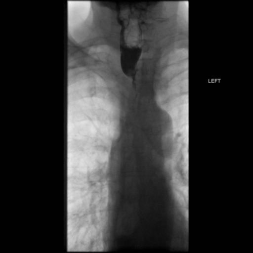 File:Anastomotic stricture post Ivor Lewis esophagectomy (Radiopaedia 47937-52715 B 1).png