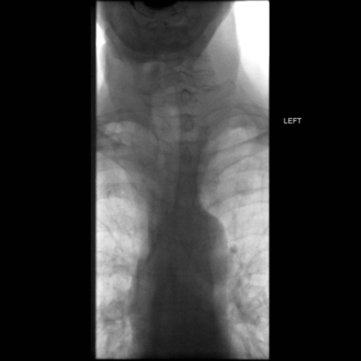 File:Anastomotic stricture post Ivor Lewis esophagectomy (Radiopaedia 47937-52715 Frontal 1).png