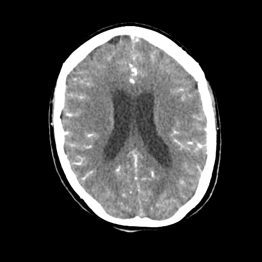 Aneursym related subarachnoid hemorrhage with hydrocephalus (Radiopaedia 45105-49084 D 33).jpg