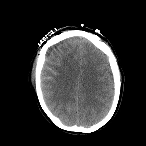 Aneursym related subarachnoid hemorrhage with hydrocephalus (Radiopaedia 45105-49085 Axial non-contrast 35).jpg