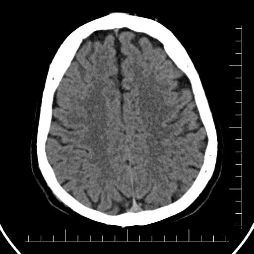 File:Aneurysm of posterior communicating artery (Radiopaedia 20188-20162 Axial non-contrast 35).jpg