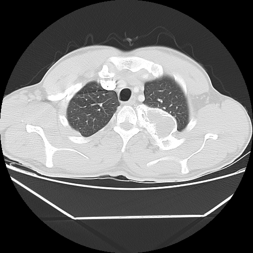 File:Aneurysmal bone cyst - rib (Radiopaedia 82167-96220 Axial lung window 19).jpg