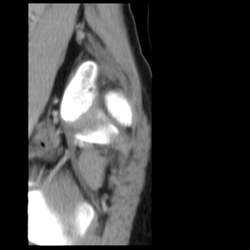 File:Aneurysmal bone cyst - sacrum (Radiopaedia 65190-74195 A 3).jpg