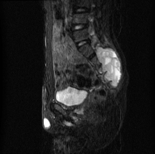 File:Aneurysmal bone cyst - sacrum (Radiopaedia 65190-74196 Sagittal STIR 15).jpg