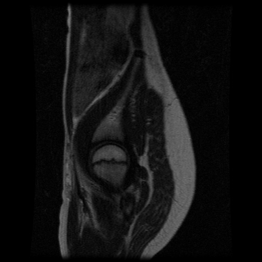 File:Aneurysmal bone cyst - sacrum (Radiopaedia 65190-74196 Sagittal T2 5).jpg