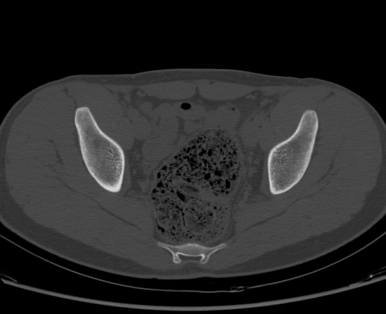 File:Aneurysmal bone cyst of ischium (Radiopaedia 25957-26094 Axial bone window 44).png