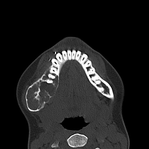 Aneurysmal bone cyst of the mandible (Radiopaedia 43280-46601 Axial bone window 21).jpg