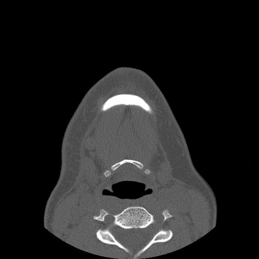 Aneurysmal bone cyst of the mandible (Radiopaedia 43280-46823 Axial bone window 6).jpg
