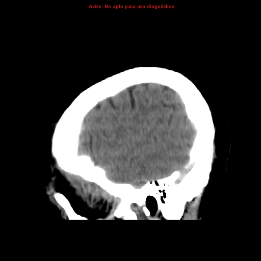 File:Aneurysmal subarachnoid hemorrhage (Radiopaedia 24740-24997 non-contrast 46).jpg