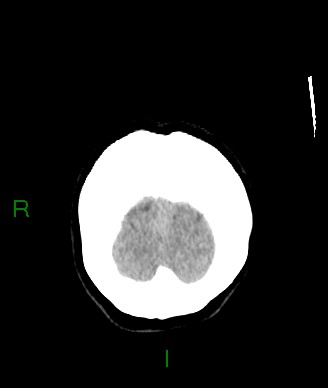 Aneurysmal subarachnoid hemorrhage with intra-axial extension (Radiopaedia 84371-99699 Coronal non-contrast 8).jpg