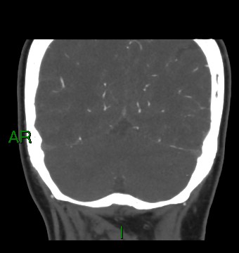 Aneurysmal subarachnoid hemorrhage with intra-axial extension (Radiopaedia 84371-99732 C 26).jpg